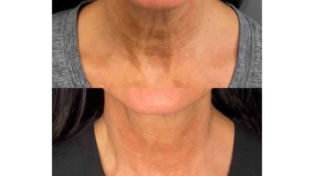 before-after-neck