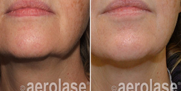 neoskin-b-a-aerolase-aesthetic-couture-in-greensboro-nc