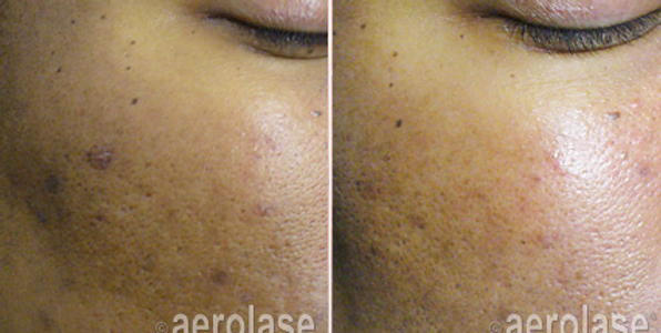neoskin-b-a-four-aesthetic-couture-in-greensboro-nc