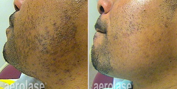 neoskin-before-after-one-aesthetic-couture-greensboro-nc