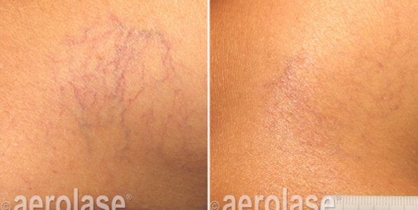 spider-veins-neoskin-b-a-three-aesthetic-couture-in-greensboro-nc