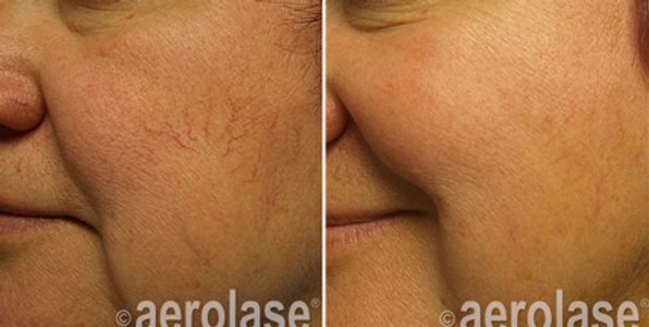 spider-veins-neoskin-b-a-two-aesthetic-couture-in-greensboro-nc
