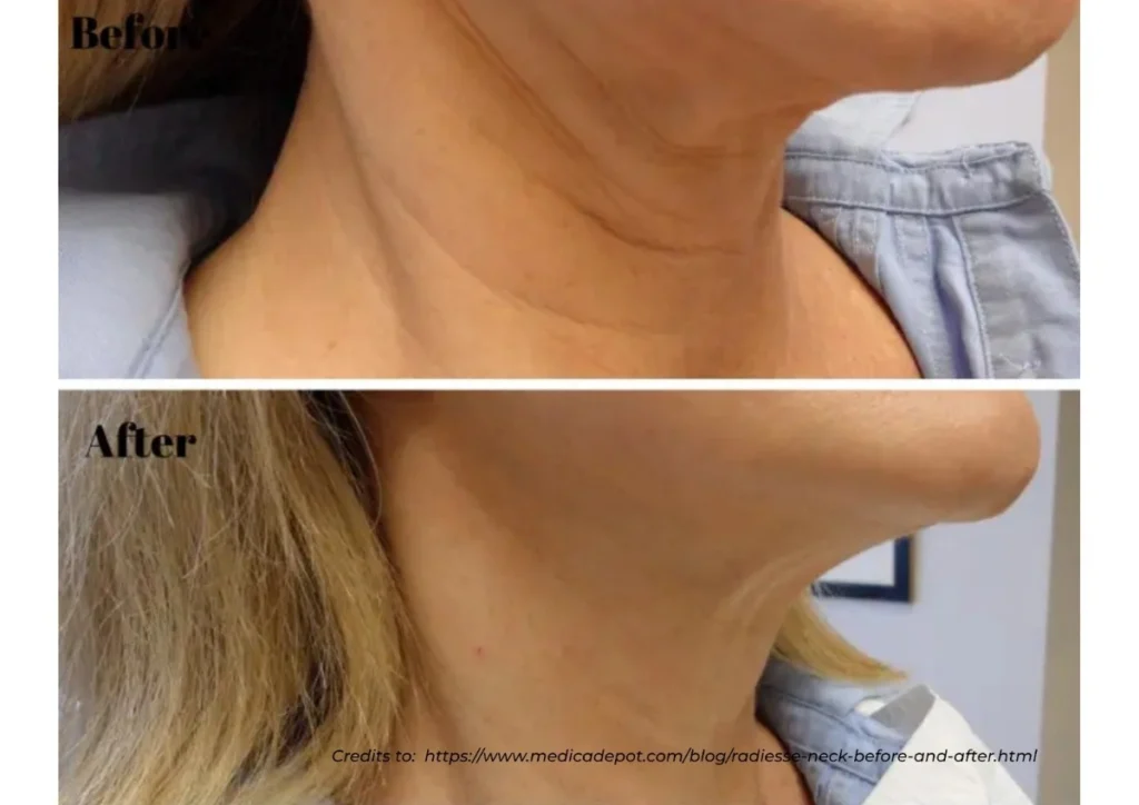 before-after-neck