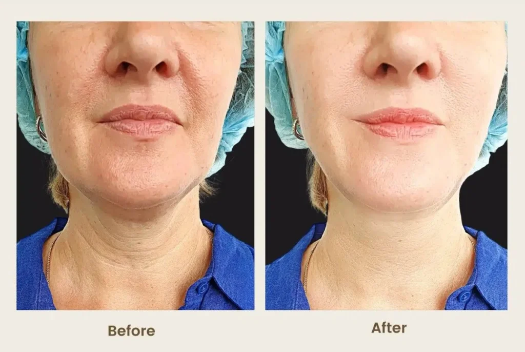 before-after-neck